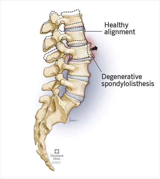 Bel Kayması, Omurga, Spondilolistezis