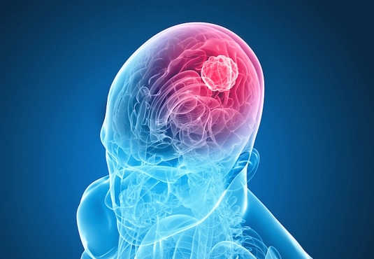 Beyin Tümörü